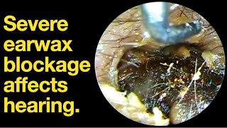 Severe earwax blockage affects hearingear wax removal  ear cleaning  ASMR  relaxation  relax [upl. by Nolrac]