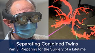 Separating Conjoined Twins Part 3 Preparing for the Surgery of a Lifetime [upl. by Ashford]