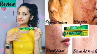 Choasma Care Cream For HyperPigmentation Pimples Blemishes Stretch Marks Review Usages Pros [upl. by Inaliel]