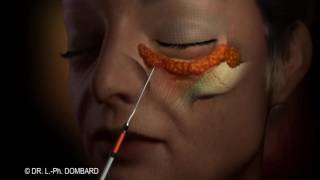 Chirurgie des cernes paupières et des Poches Blépharoplastie  Animation 3D © DR Dombard [upl. by Etnwahs]