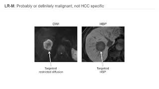 Imaging HCC and LIRADS [upl. by Glynis]