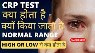 CRP test kya hota hai  crp test in hindi  crp test normal range  crp high hone se kya hota hai [upl. by Lednew575]