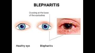 Blepharitis Definition of blepharitis Causes of blepharitis✨ [upl. by Cassiani]