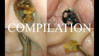 4 CASES  SEVERE EAR  COUGH REFLEX  CERUMEN IMPACTION  FOREIGN BODY  SYNDROMIC EARS [upl. by Veljkov]