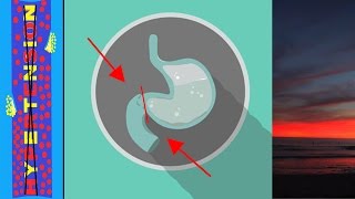 Pyloric Stenosis and Metabolic Alkalosis [upl. by Letnohs]