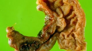 Meckels diverticulum  Pathology mini tutorial [upl. by Annaiek782]