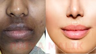 How To Remove Dark Black patches Dark SpotsHyper pigmentation Around Your Mouth  PRIYA MALIK [upl. by Yrebmik]