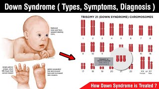 Down syndrome  types of down syndrome  symptoms treatment diagnosis in Hindi [upl. by Nodla]