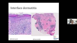 Global Dermatology Talks 11272023  Silvija Gottesman [upl. by Nonnaihr]