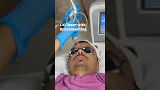 Co2 fractional laser with microneedling Treatment skin smile clinic Bhopal ✅skincare [upl. by Kcirdec]