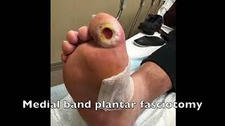 Medial Band Fasciotomy To Treat a Hallux Wound [upl. by May]