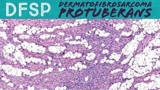 DFSP Dermatofibrosarcoma protuberans NOT a quotsebaceous cystquot or lipoma Oregon Case 5 [upl. by Luise647]