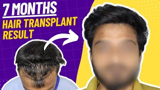 Best Hair Transplant Result  Frontal Hairline Hair Transplant  hair transplant in delhi Hairmate [upl. by Swithin]