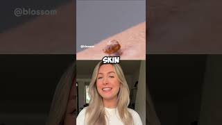 🚫 Home Skin Tag Removal Don’t Try This SkinTagRemoval [upl. by Nattirb]