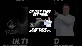 Severe Knee Effusion Ultrasound Guided Procedure [upl. by Maggie]