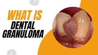 What is Dental Granuloma Causes Symptoms and Treatment [upl. by Kolivas]