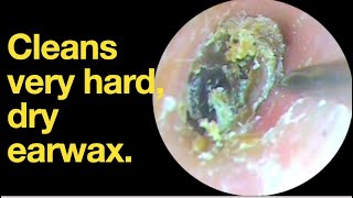 Cleans very hard dry earwax ear wax removal  ear cleaning  ASMR  relaxation  relax [upl. by Havelock958]