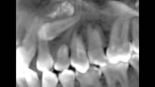 Canines incluses CBCT scan impacted cuspids orthodontie 123213 IT31 [upl. by Nanaek]