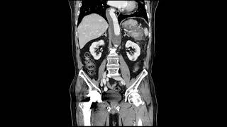 aneurysm amp IMHintramural hematoma [upl. by Yelroc]