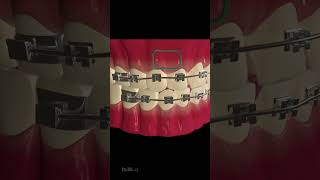 How Does Dental Braces Work [upl. by Ridglee725]