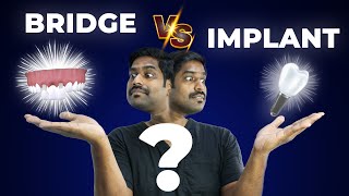 பல் கட்டுவதில் எது சிறந்த முறை   Dental Bridge Vs Dental Impant  Denta Kings [upl. by Abbotson]