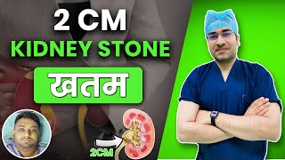 2 cm kidney stone खतम  RIRS से निकले 2cm Kidney stone  Patient from Siliguri West Bengal [upl. by Latashia470]