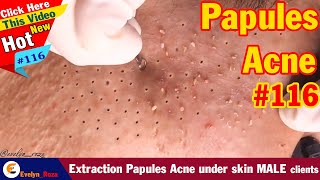 Extraction Papules Acne under skin MALE clients  Acne Treatment 116 [upl. by Arocet]