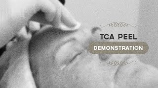 35 TCA peel demonstration [upl. by Enomis]