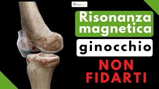 Risonanza magnetica al ginocchio NON FIDARTI [upl. by Kirre]