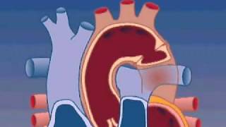 Coarctation of the Aorta [upl. by Gniliem]