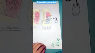 Assignment on paracentesis assignment medicalsurgicalnursing nursingnotes followformore fo [upl. by Riccio]