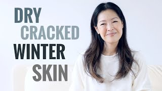 Tips For Treating Dry Cracked Winter Skin  Body [upl. by Iz]