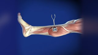 Cause of Entrapment Syndromes in Gastrocnemius Muscle A Prospective Study [upl. by Jarrod]