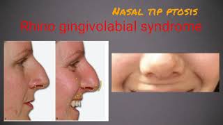 Nasal tip lift and nasal flare correction by botox [upl. by Yseult]