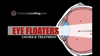 What Causes Floaters in Your Vision and Black Dot in Eye [upl. by Netsruk]