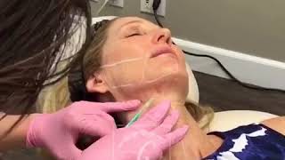 Dr Bonakdar Performs quotMicroBotox Necktoxquot for Necklace Lines  Newport Beach CA  PART 1 [upl. by Sinnel]