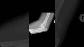 Posterior dislocation of the elbow with associated fracture of the coronoid process xray [upl. by Silvestro183]