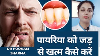 पायरिया को जड़ से खत्म करने का इलाज  Pyorrhea Treatment Pyorrhea Ko Jad Se Khatam Karne ka Ilaj [upl. by Hiamerej]