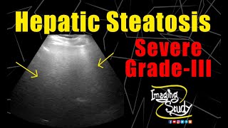 Severe Hepatic Steatosis  Severe Fatty Infiltration  Ultrasound  Case 172 [upl. by Nivlac134]