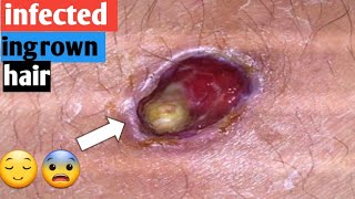 ingrown hair  infected ingrown hair removal so satisfying 😌 👍 [upl. by Atilegna]