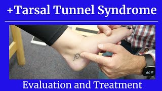 Positive Tarsal Tunnel SyndromeEval and Treatment [upl. by Marilla]