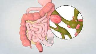 Patient Teaching Left Hemicolectomy Sigmoid Colectomy  TVASurg [upl. by Ennaillek]