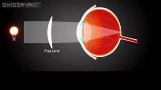 Inside the Eye Farsightedness Hyperopia [upl. by Aneloaup]