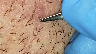 Infected ingrown hairs on neck [upl. by Anits]