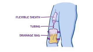 Texas Catheter  Definition Characteristics and Uses [upl. by Efron]