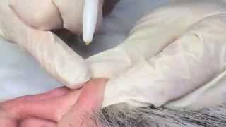 Electrolysis Treatment On Tragus and Ears [upl. by Ecyla977]