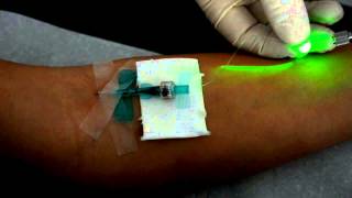 Intravenöse Laserblutbestrahlung mit dem Weberneedle® Endo Laser [upl. by Aciruam869]