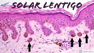 Solar Lentigo vs Lentigo Maligna Melanoma In Situ on ‪SOX10‬ Stain 5Minute Pathology Pearls [upl. by Eremahs]