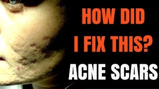 How to treat acne scars  Dermatologist explains [upl. by Bleier]