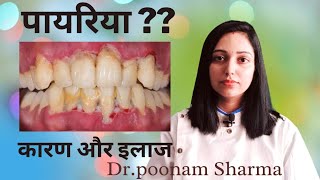 पायरिया क्यों होता है और इसको कैसे ठीक किया जाता है Pyorrhea ka Treatment periodontitis [upl. by Blessington]